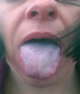 Painful-whiteish-blue-tongue-discoloration-caused-by-cold-air-followed-by-normal-colour~3