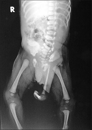 Radiograph_of_a_child_with_polymelia
